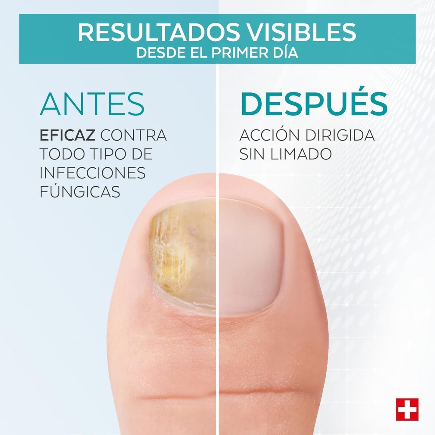 Tratamiento uñas PODERM | A1287