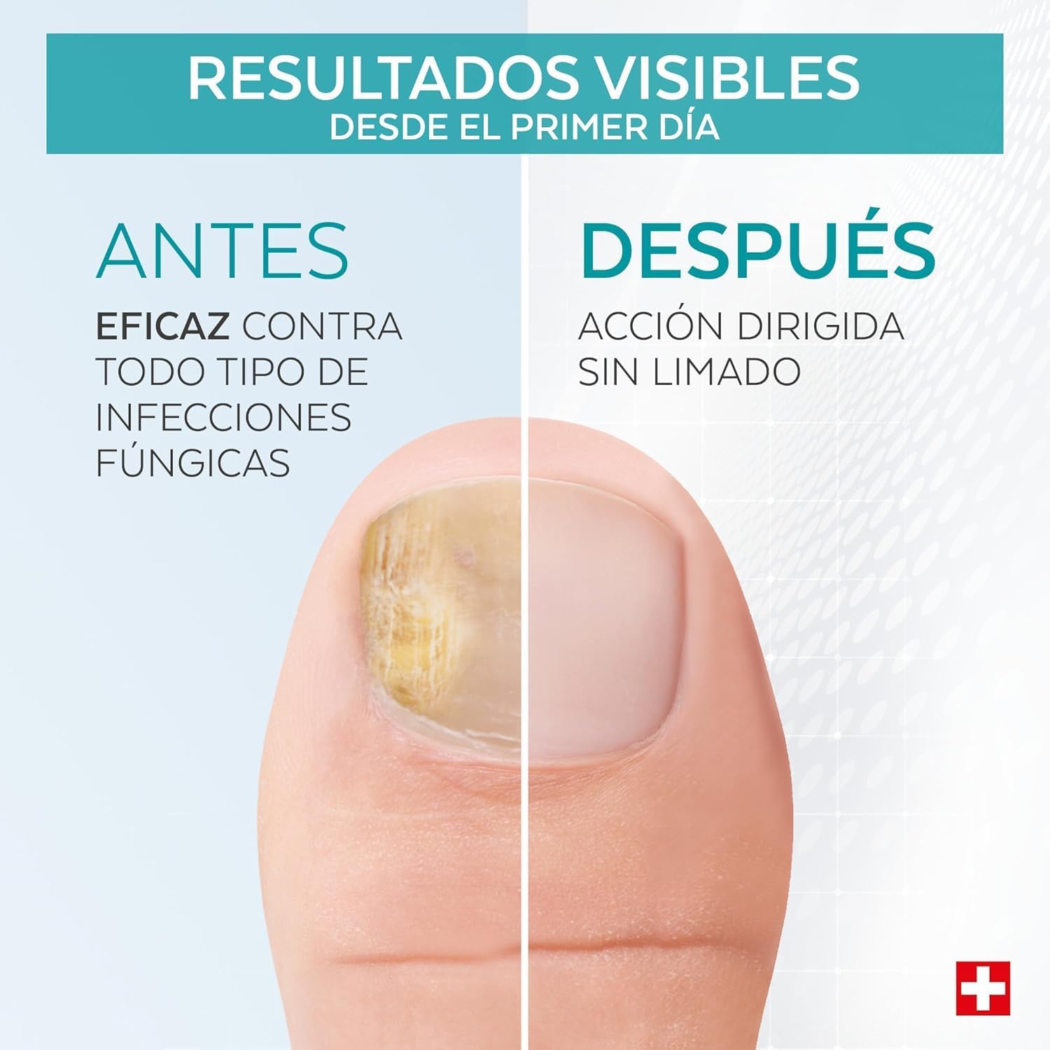 Tratamiento uñas PODERM | A1287